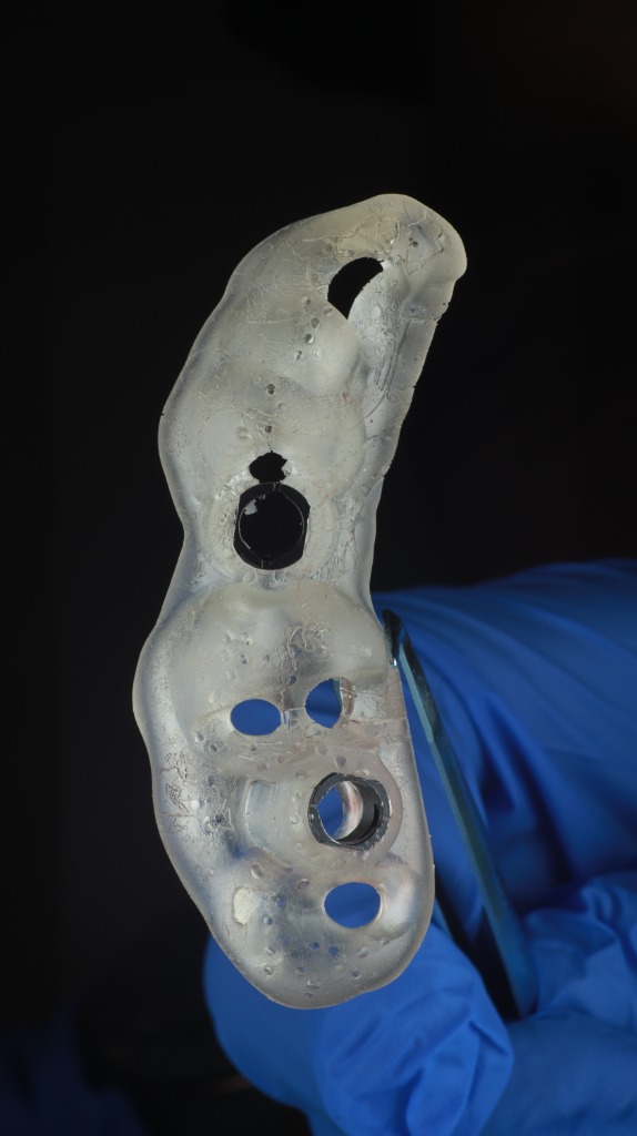 Tooth-Supported Partial Guide